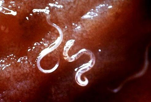 parazity vo vnútri tela